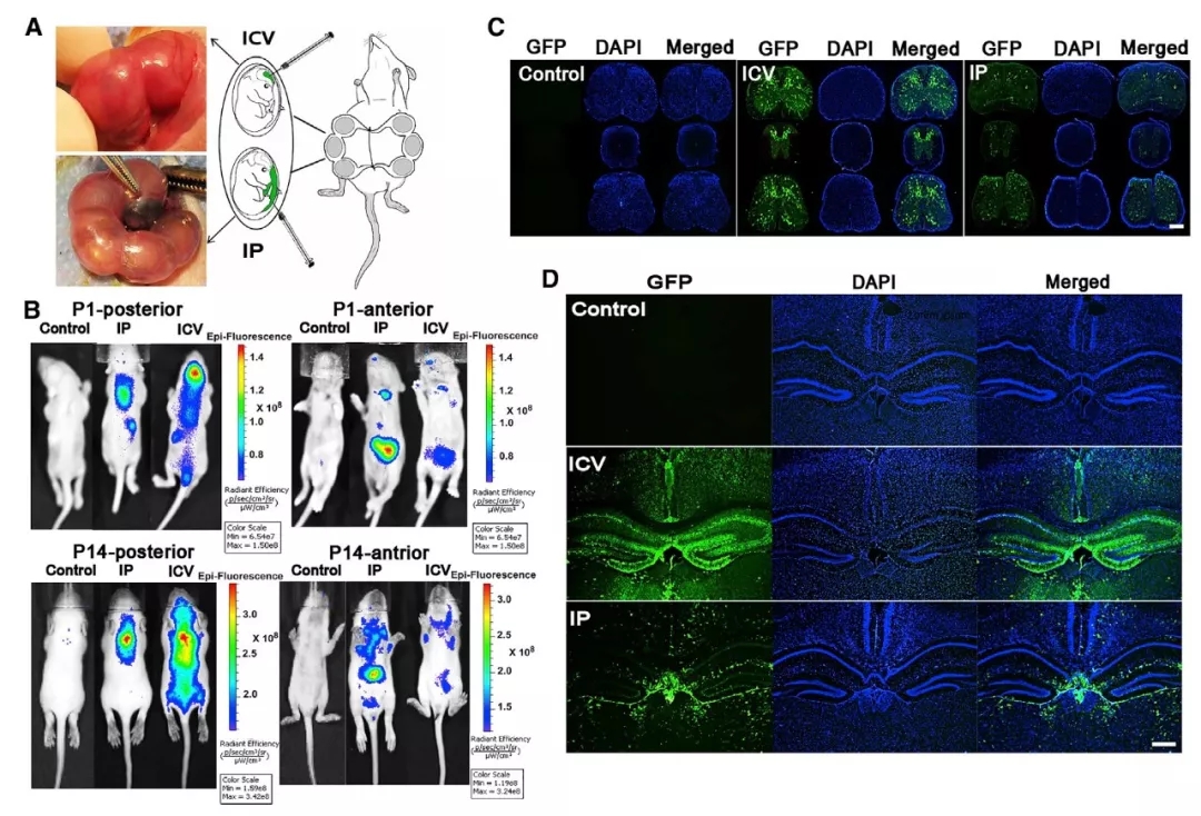 与时间赛跑，基于rAAV9载体胎儿基因治疗SMA新进展（二）